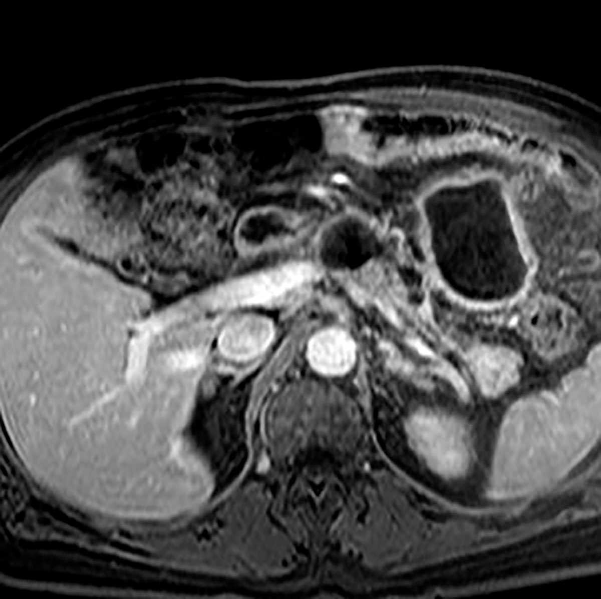 Chronic pancreatitis - CTisus CT Scan