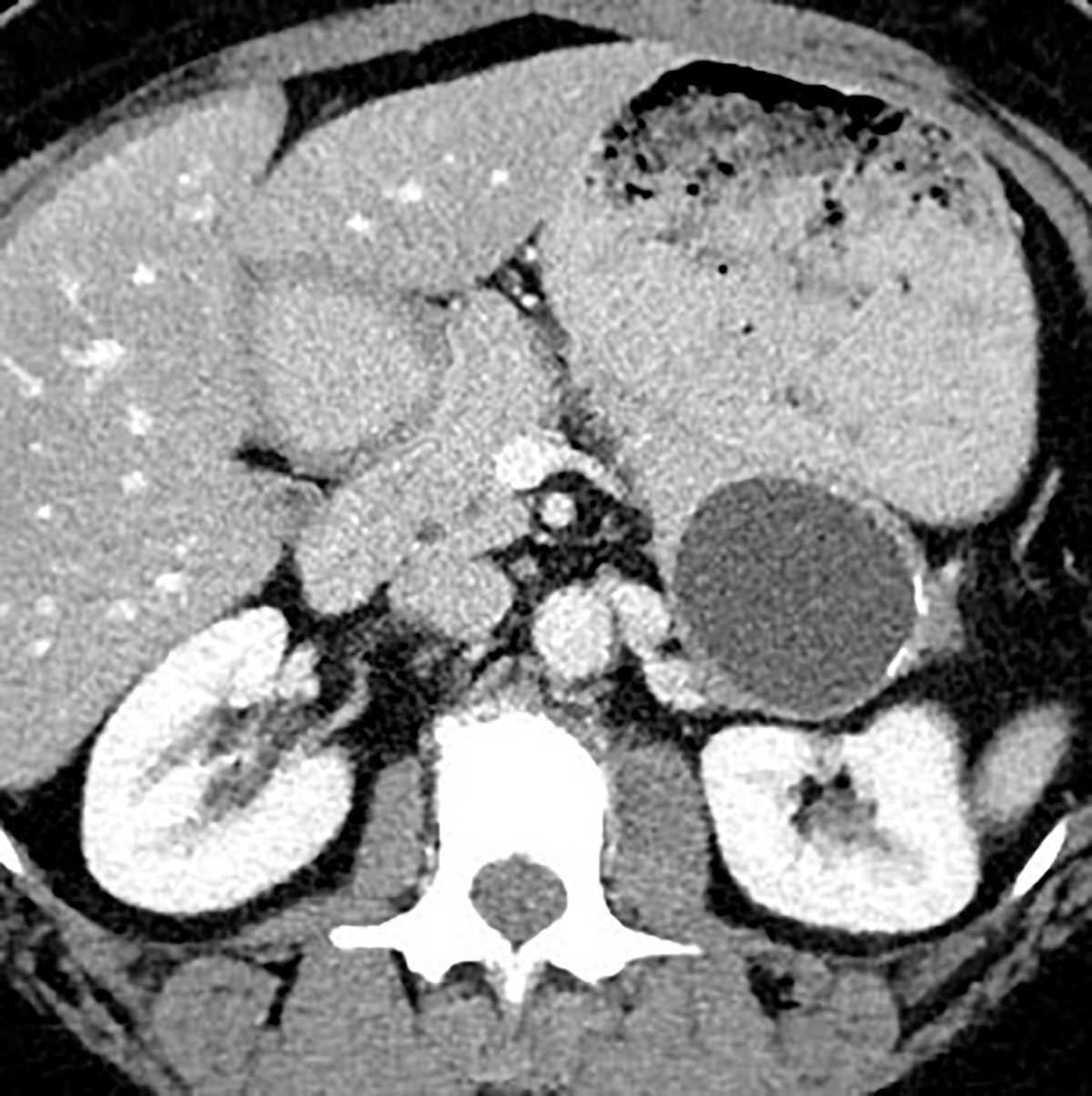 Mucinous cystic neoplasm (MCN) - CTisus CT Scan