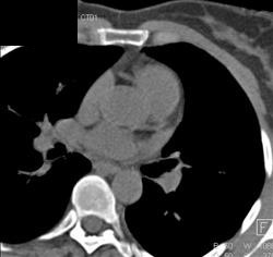 Normal Coronary Artery Scoring Study - CTisus CT Scan