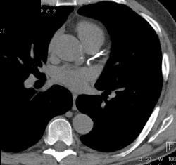 Calcified LAD and Left Main Coronary Artery - CTisus CT Scan