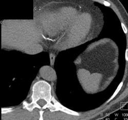 LAD and Right Coronary Calcification. Agatston Score Was Above 800 Au - CTisus CT Scan