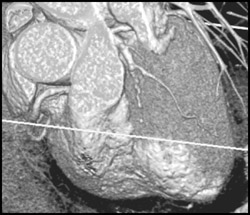 Stenosis in LAD - CTisus CT Scan