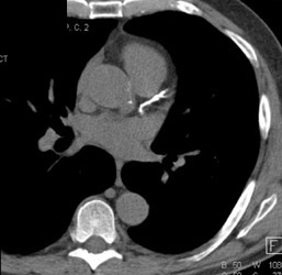 Diseased LAD With Score of >500 Angston Units - CTisus CT Scan