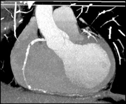 Significant Stenosis in Right Coronary - CTisus CT Scan