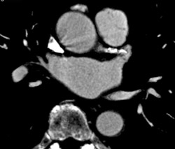 Calcified LAD - CTisus CT Scan