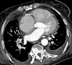 Normal Aortic Root - CTisus CT Scan