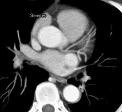 Normal Left Coronary Arteries - CTisus CT Scan