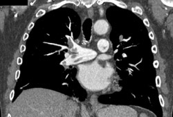 Pulmonary Embolism - CTisus CT Scan