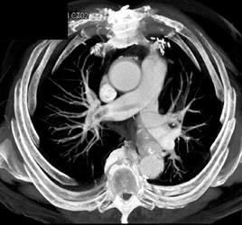 Pulmonary Embolism - CTisus CT Scan