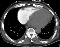 Contrast in Right Side of Heart - CTisus CT Scan