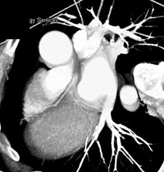 Normal Left Coronary Artery - CTisus CT Scan