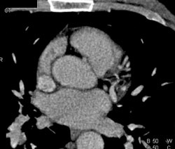 Plaque in Right Coronary Artery - CTisus CT Scan