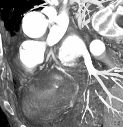 Plaque in LAD With Stenosis - CTisus CT Scan