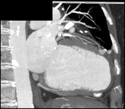 Enlarged Left Ventricle - CTisus CT Scan