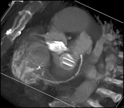 Open and Closed Aortic Valve - CTisus CT Scan