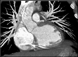 Coronary Artery Stent - CTisus CT Scan