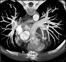 Coronary Artery Bypass Grafts - CTisus CT Scan