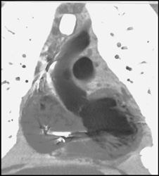 Endoluminal Imaging - CTisus CT Scan