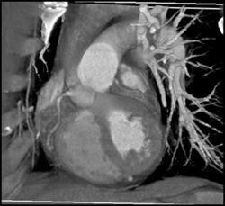 Coronary Artery in Normal CTA - CTisus CT Scan