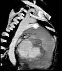 Patent Ductus Embolized With Coils - CTisus CT Scan