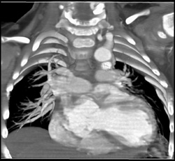 Dilated Left Ventricle - CTisus CT Scan