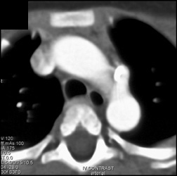 Post Ductus Repair - CTisus CT Scan