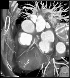 Coronary Artery CTA - CTisus CT Scan