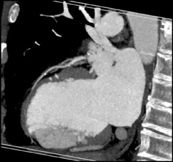 Mild Disease in LAD - CTisus CT Scan