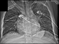 Calcified Pericardium and Constrictive Pericarditis - CTisus CT Scan