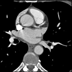 Soft and Calcified Plaque in LAD - CTisus CT Scan