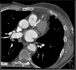 Extensive Coronary Artery Disease - CTisus CT Scan