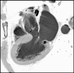 Diseased LAD - CTisus CT Scan