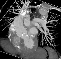 Diseased Aortic Valves - CTisus CT Scan