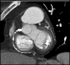 Extensive Coronary Artery Calcification - CTisus CT Scan