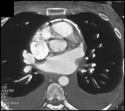 Calcified Pericardium - CTisus CT Scan