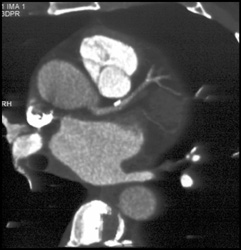 Plaque on LAD - CTisus CT Scan