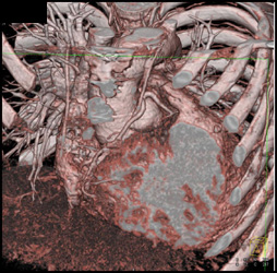 Coronary CTA - CTisus CT Scan