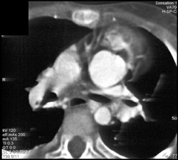 Common Ventricle - CTisus CT Scan