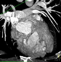 Normal Origins of Right and Left Coronary Artery - CTisus CT Scan