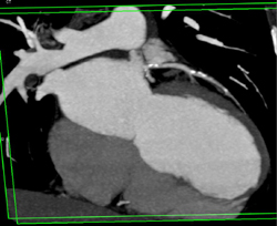 Calcified Plaque in RCA and LAD - CTisus CT Scan