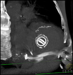 Normal Aortic Valve- Aortic Valve Replacement (AVR) - CTisus CT Scan