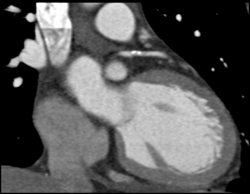 Calcified Plaque in LAD Coronary Artery - CTisus CT Scan