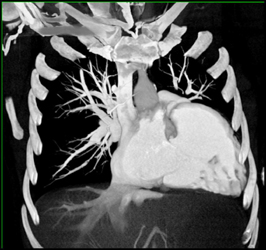 Enlarged Lv - CTisus CT Scan