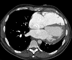 Enlarged Lv and Rv - CTisus CT Scan