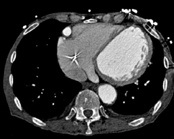 Saphenous Vein Graft Aneurysm - CTisus CT Scan