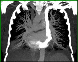 Left SVC Emptying Into the Coronary Sinus - CTisus CT Scan