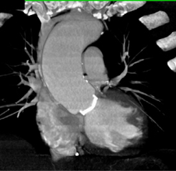 Normal Aortic Valve Replacement -closed/open - CTisus CT Scan