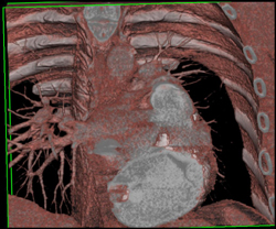 Dilated Coronary Sinus - CTisus CT Scan