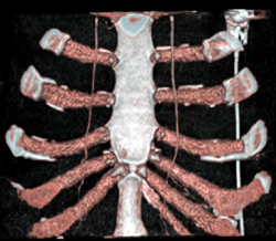 Normal Internal Mammary Arteries - CTisus CT Scan