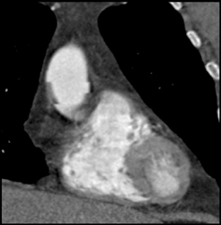 Arrhythmias Causing Motion on Aortic Valve - CTisus CT Scan